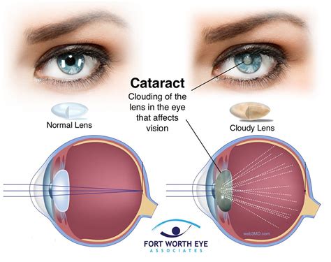 cataract surgery huddersfield